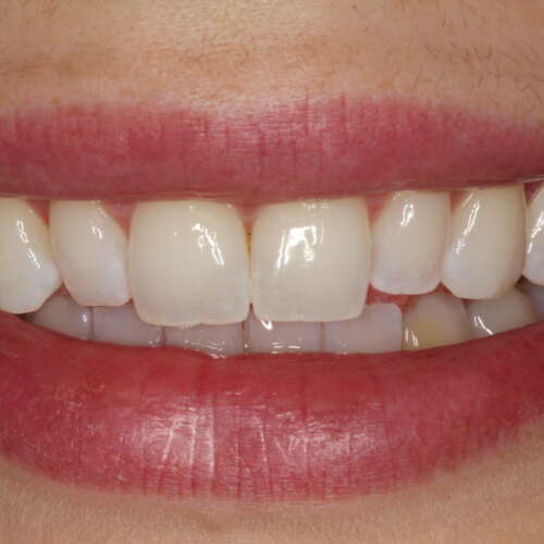 woman’s teeth before composite bonding treatment
