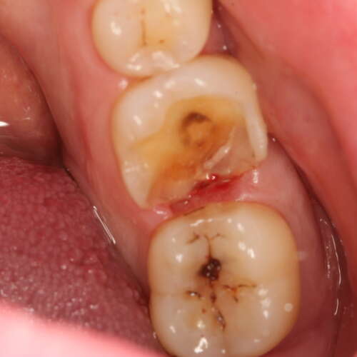 badly damaged molar tooth which has lost some cusps