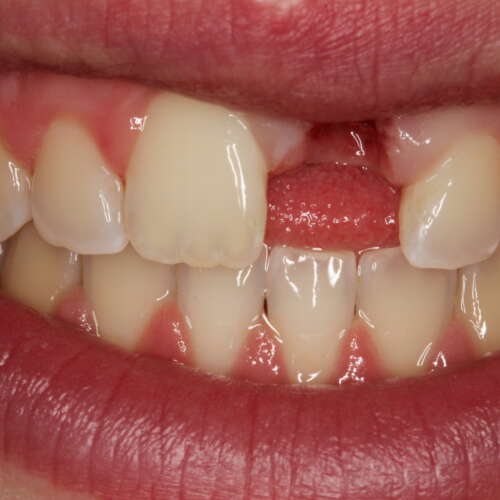Adhesive Bridge Pre