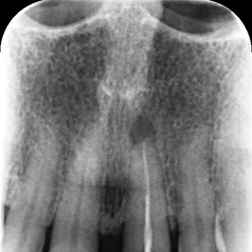 root canal infection in front tooth
