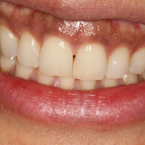 classic gingival pigmentation with a high lip line