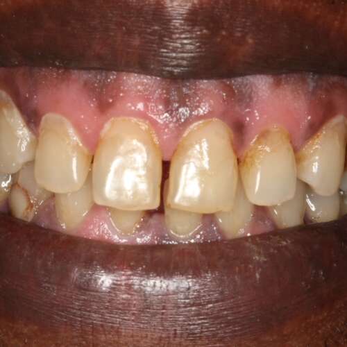 yellow stained teeth before dental treatment
