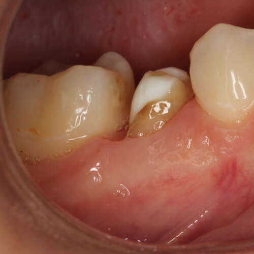 premolar tooth which has a root filling
