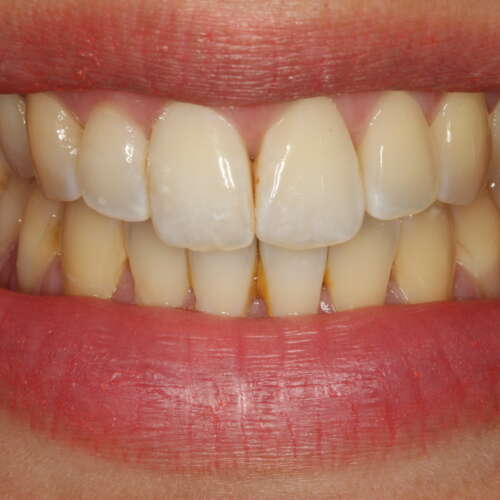 Invisalign expansion before