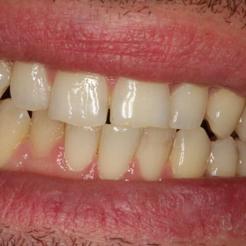 mouth before invisalign comprehensive treatment has classic tooth crowding, uneven levels, narrow arches & worn teeth