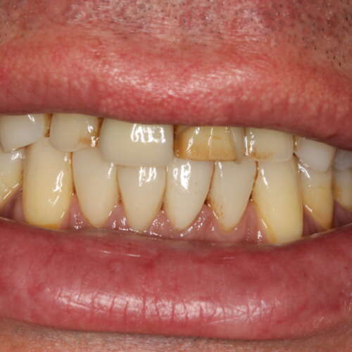 Before treatment - replace failing veneers & place veneers on adjacent teeth for symmetry