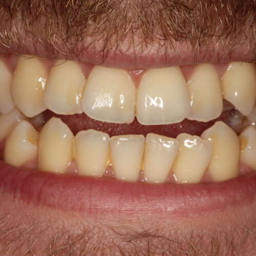 narrow arches associated with a 'buccal corridor' where the back teeth cannot be seen on smiling