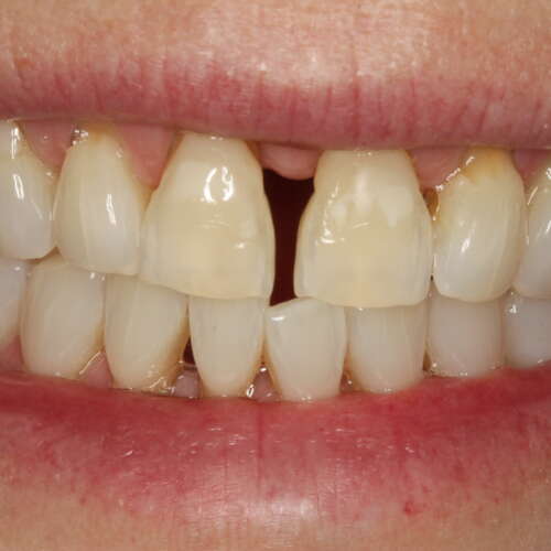 large space between the front teeth increased over time through gum disease