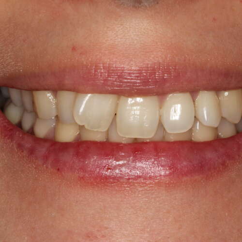 severely rotated front tooth