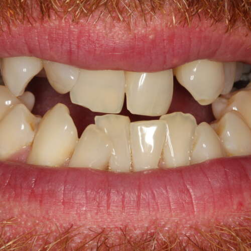 dental issues with crowding, rotations, lack of space, hidden teeth & uneven edges