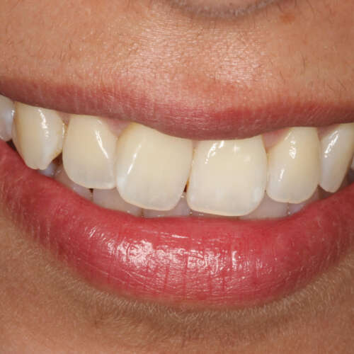 right central incisor rotated outwards before invisalign for rotated teeth