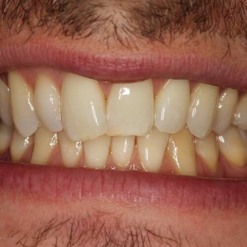 crowding of upper & lower teeth, uneven edges, yellow shade