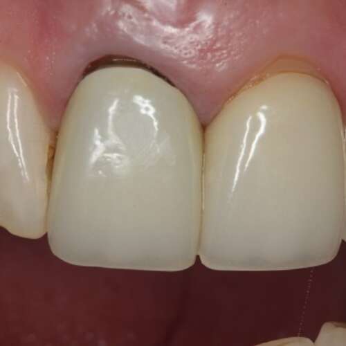 before fully customised crown