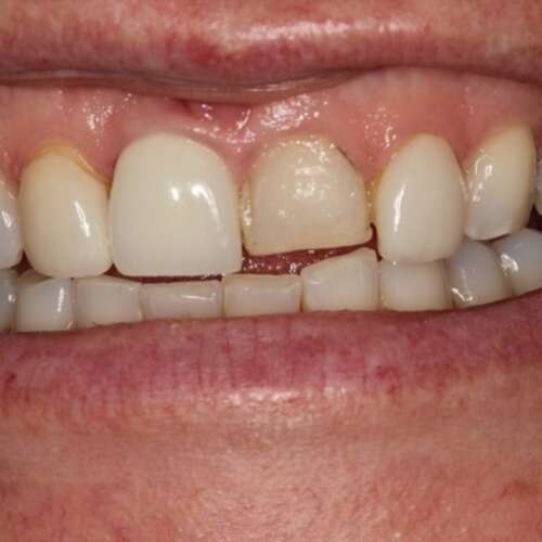 before porcelain veneers