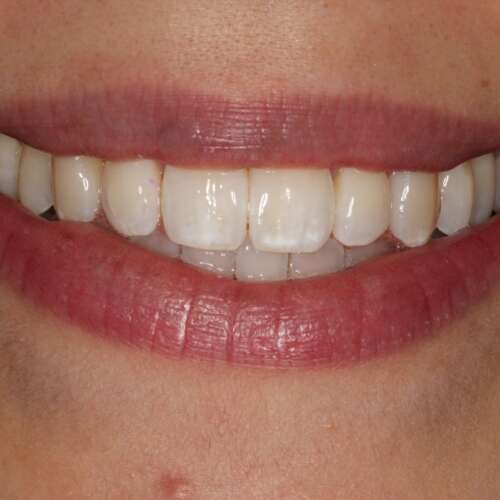 after Invisalign rotated teeth striaghtened