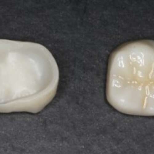 zirconia crowns