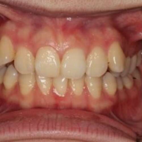 before ceramic orthodontic treatment