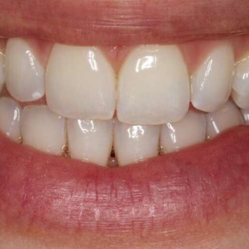 Before cosmetic bonding