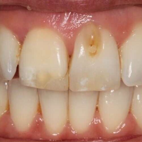 before cosmetic bonding
