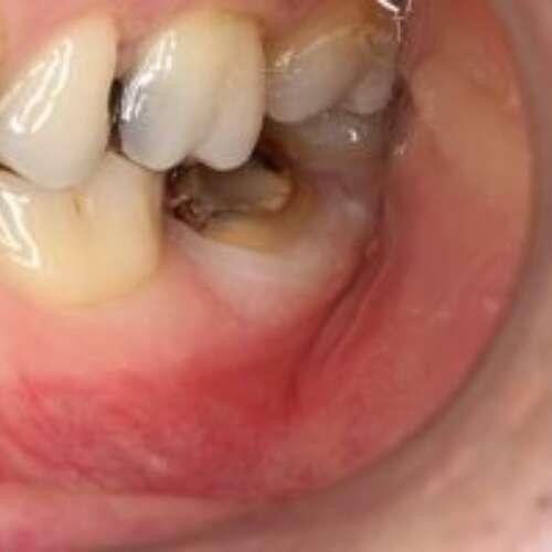 broken down back tooth