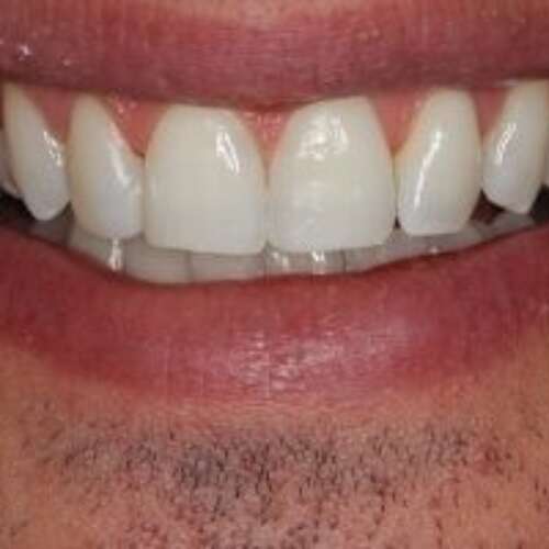 Composite veneers on front 4 teeth