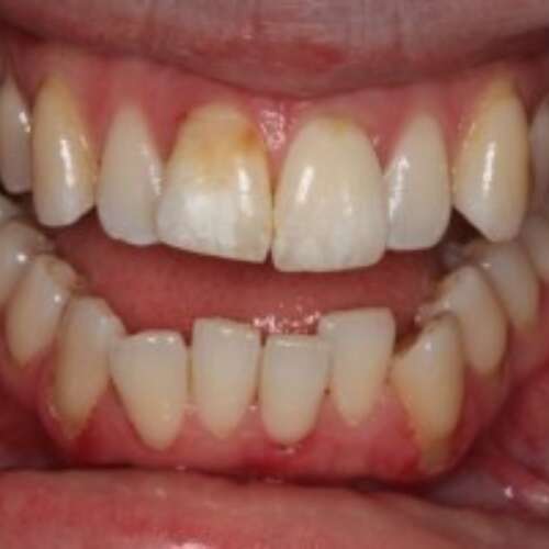 Crooked upper lower teeth