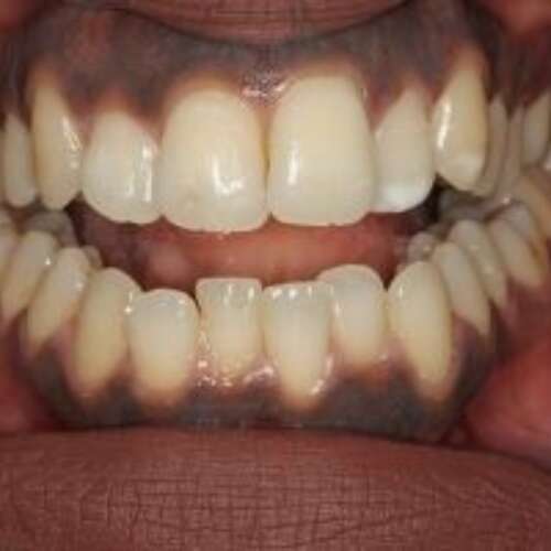 crowded lower front teeth