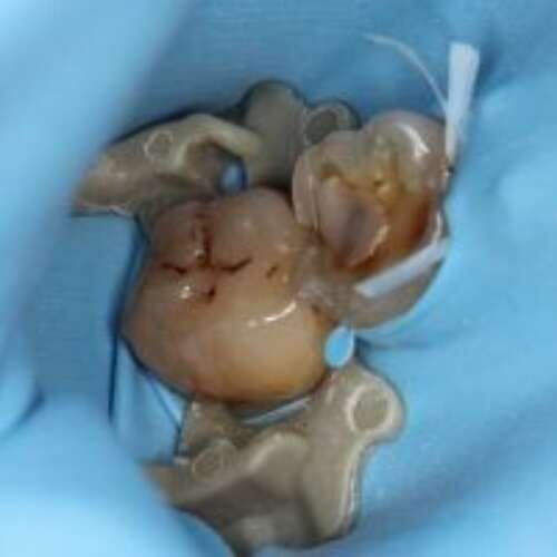 decayed broken molar teeth