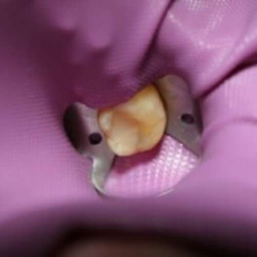 dental dam