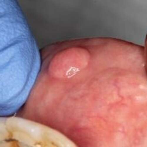 fibroepithelial polyp inside lower lip