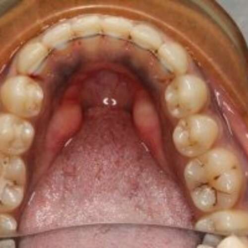 fixed wire retainers placed on lower front teeth
