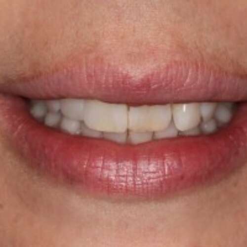 Front teeth slightly crooked