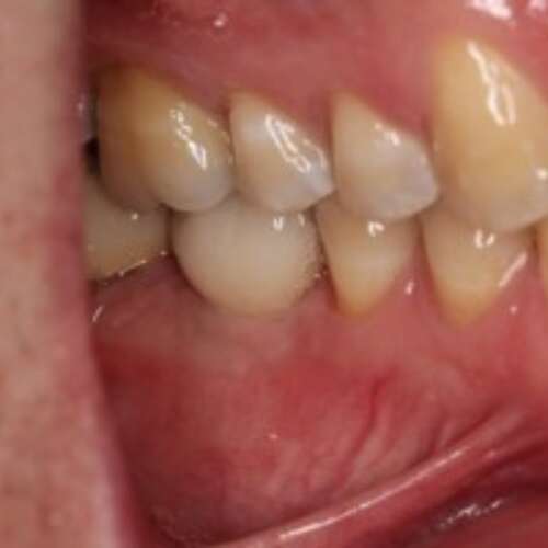 Fully restored dental implant
