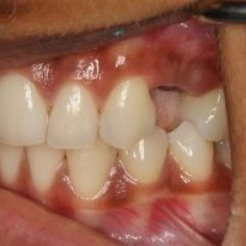 Healing abutment