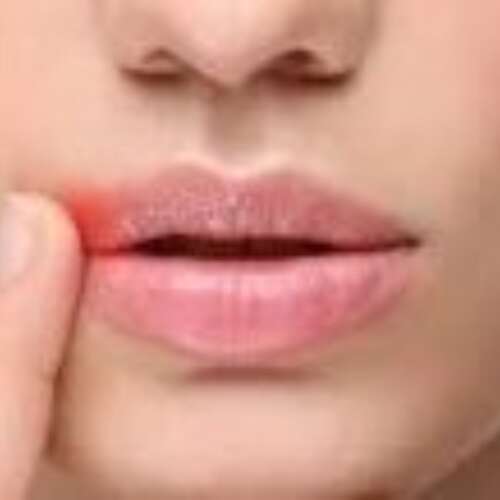 lips of woman with cold sore