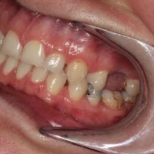 Missing molar