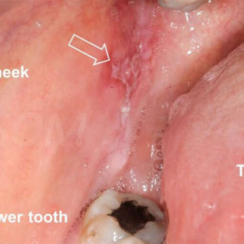 Mouth cancer