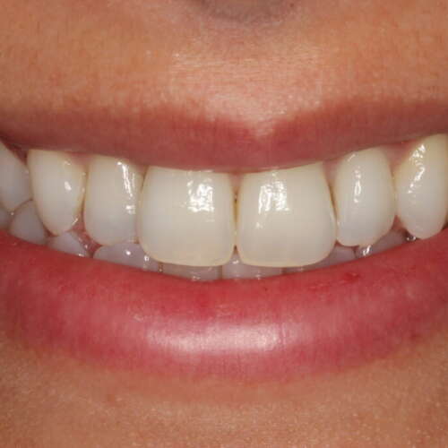 Social 6 teeth whitening 1