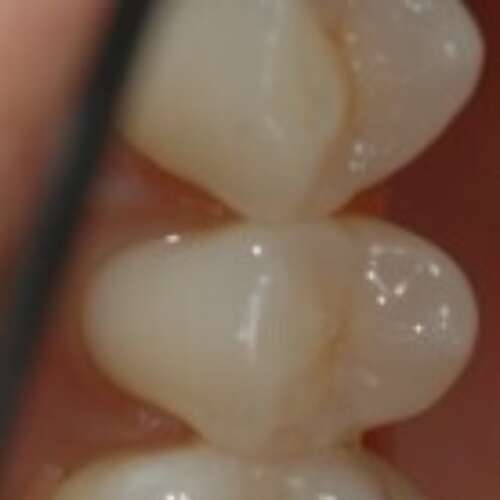 tooth with metal filling