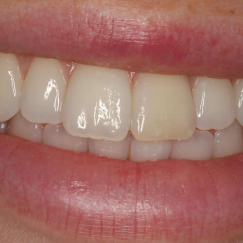 discolouration of left central incisor