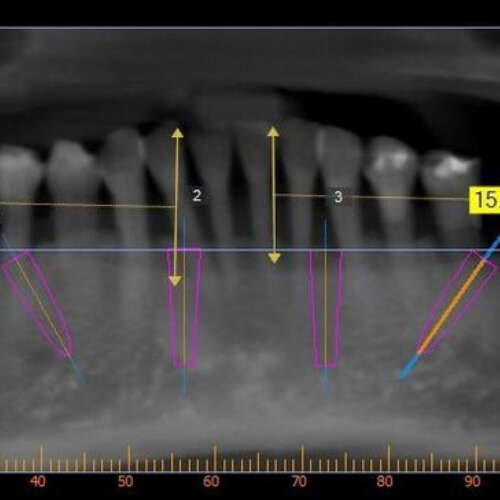 Virtual implant planning