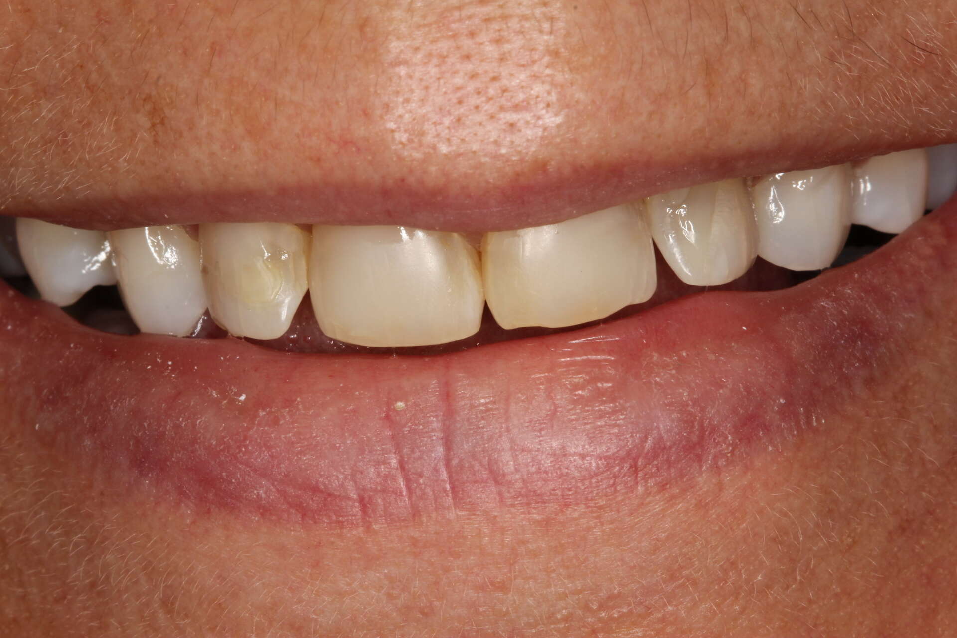 Minimally invasive veneers