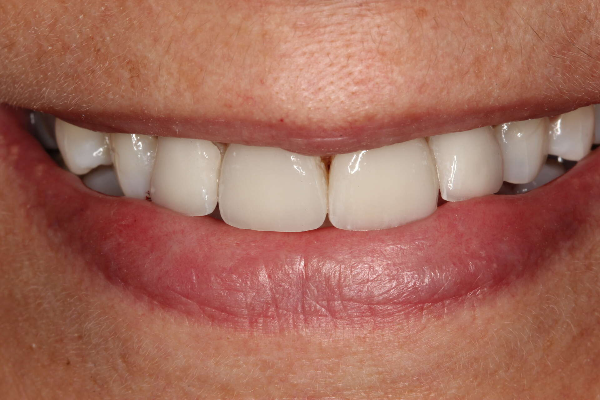 Minimally invasive veneers after