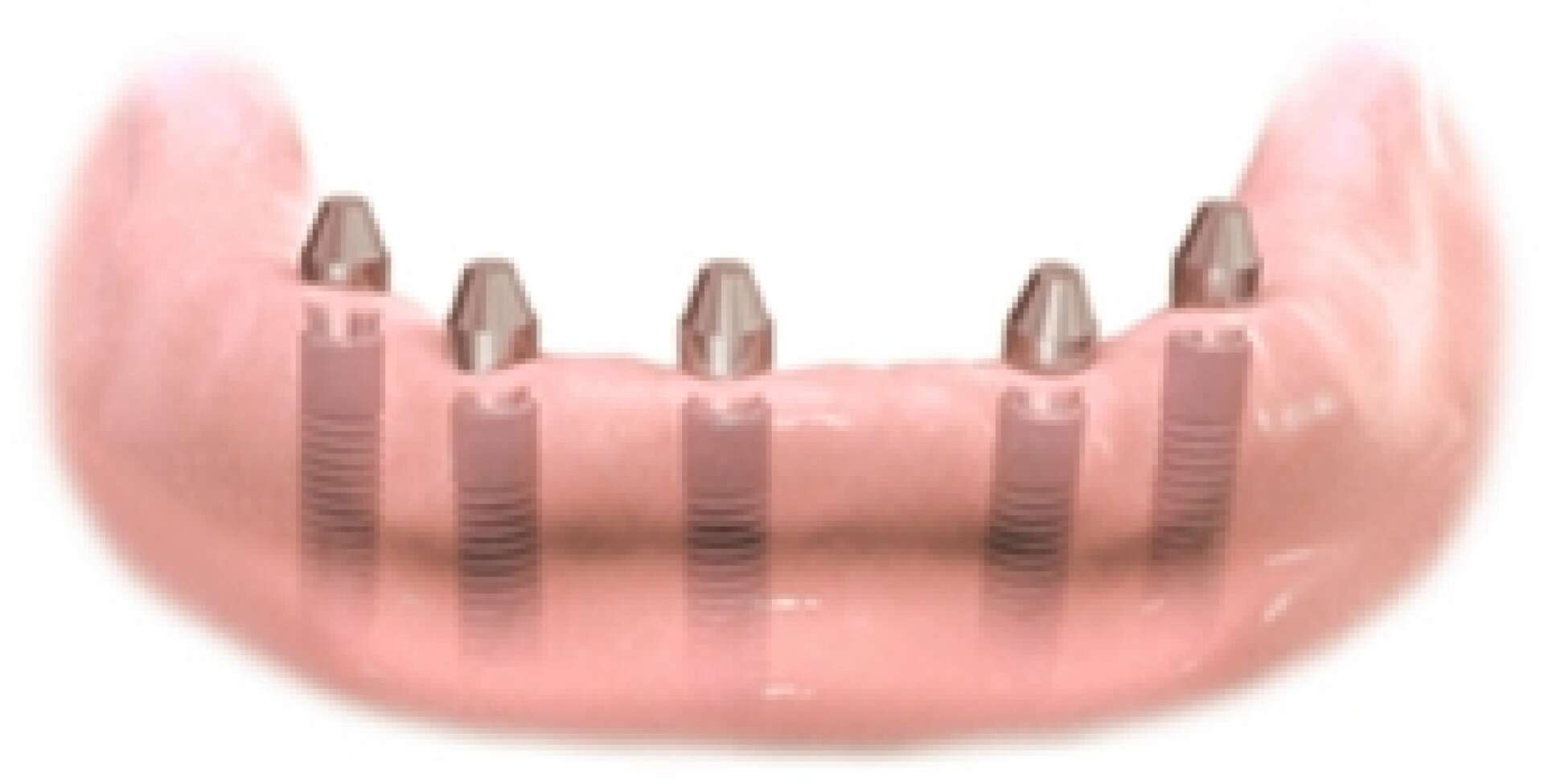 All teeth implants 2