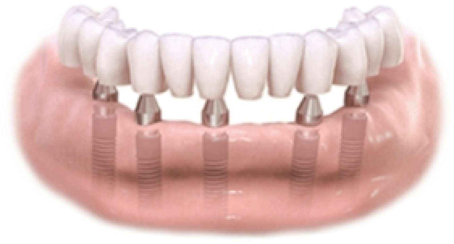 All teeth implants 3