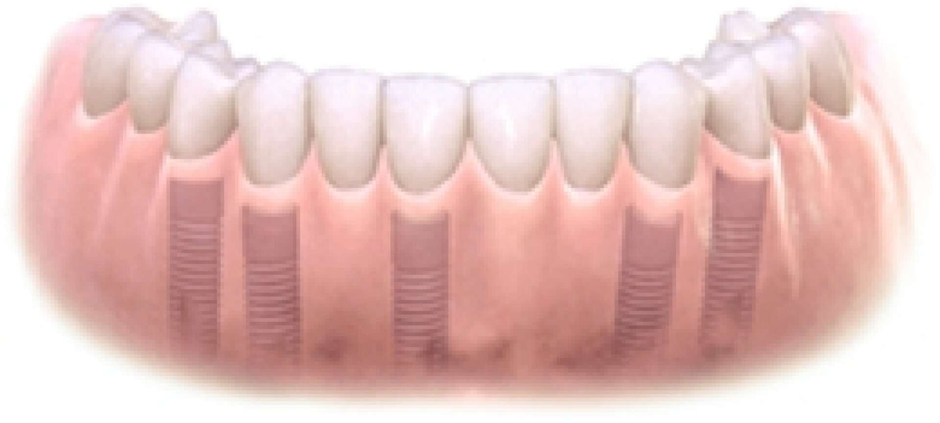 All teeth implants 4