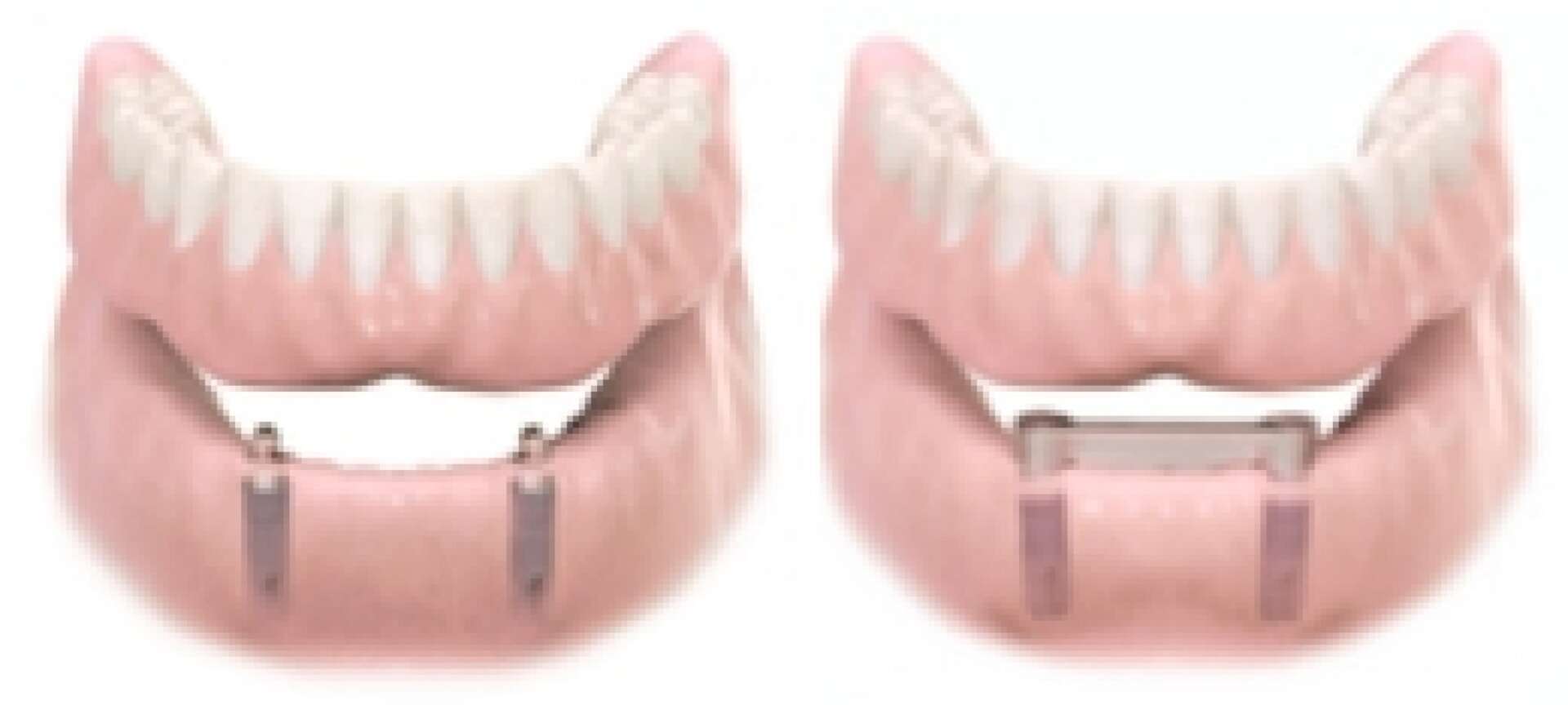 Removable Denture 3