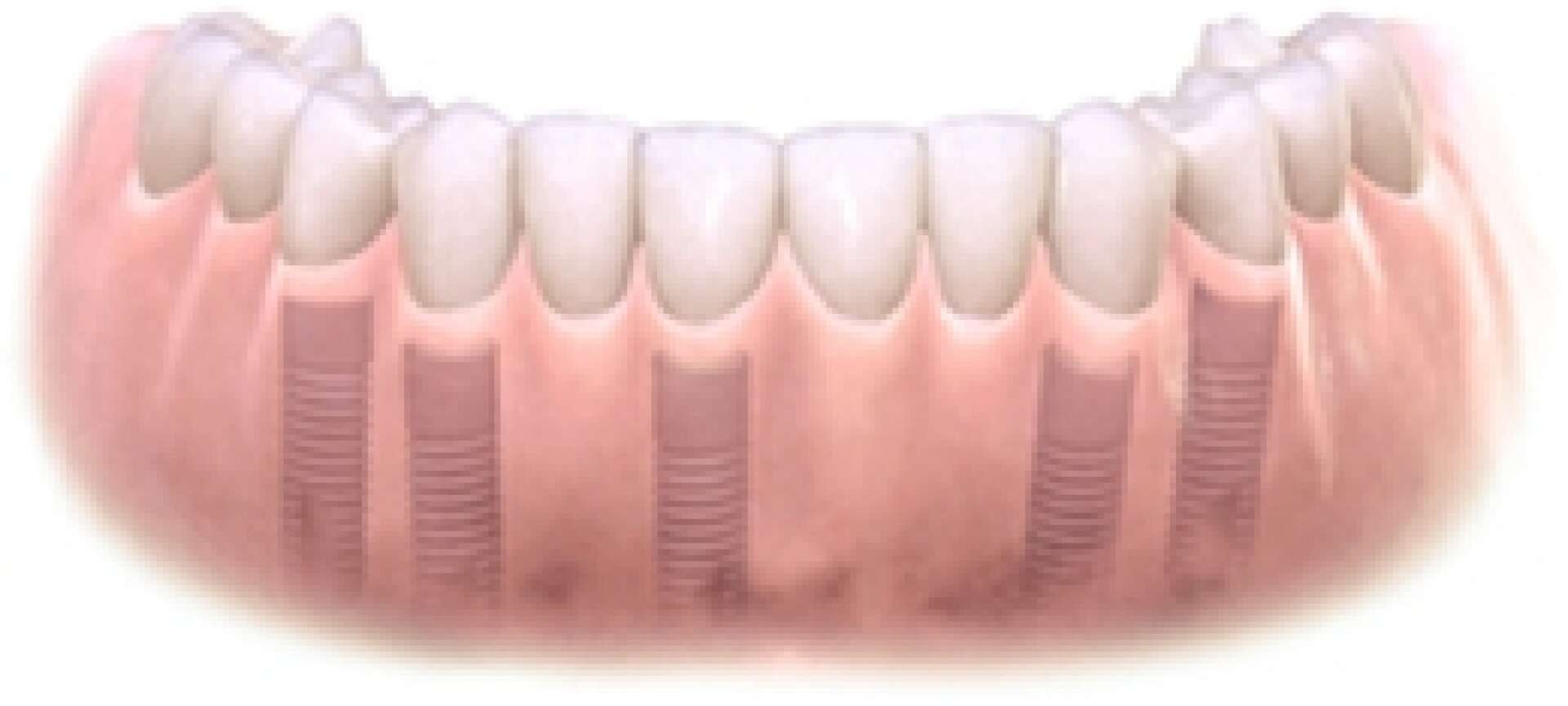 Removable Denture 4