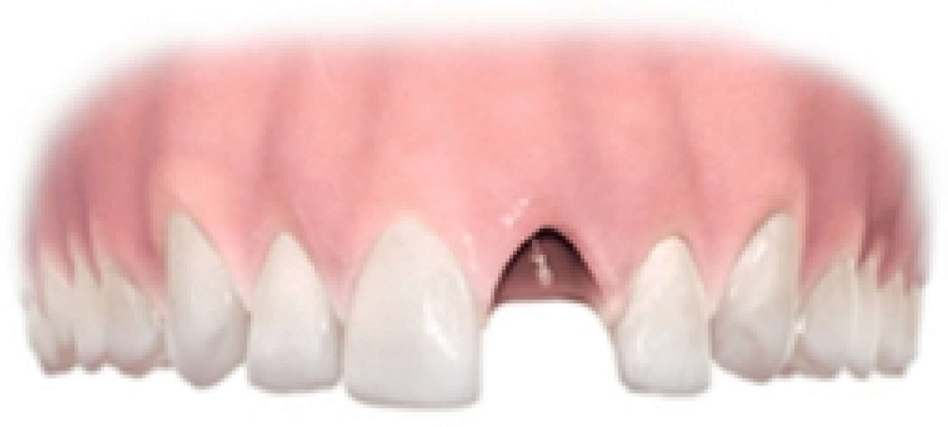 Single Tooth Implant Step 1