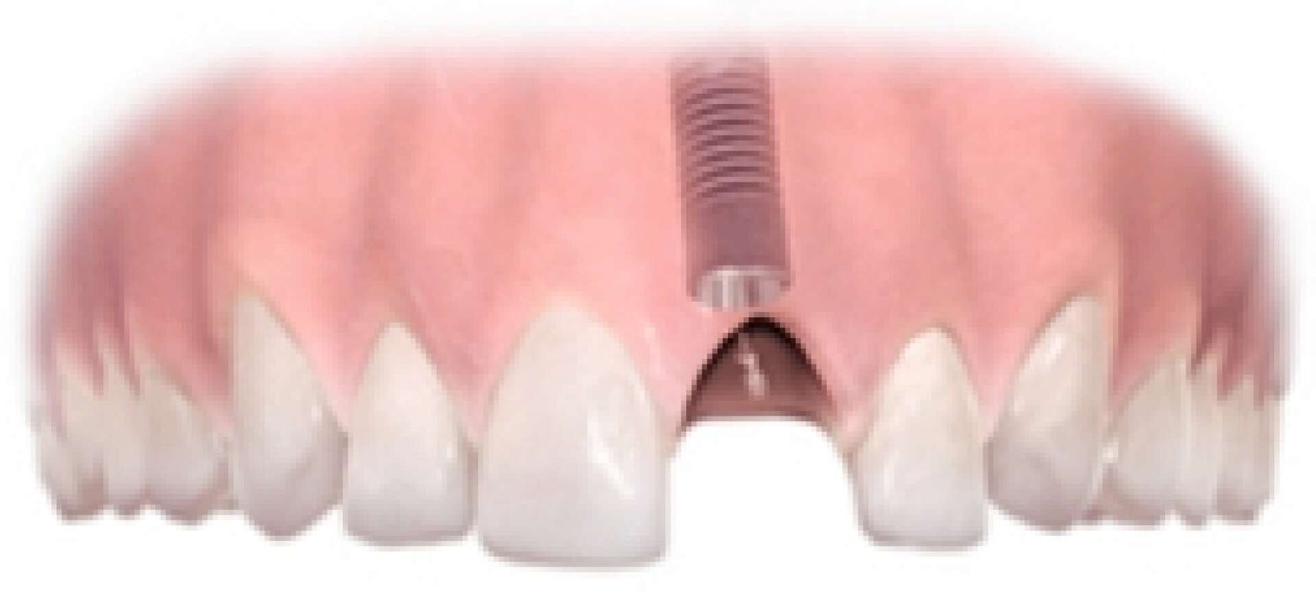 Single Tooth Implant Step 2